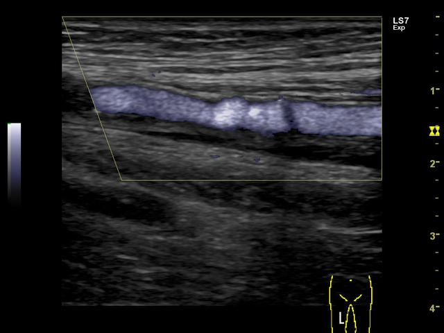 GE Logiq S7 с XDClear