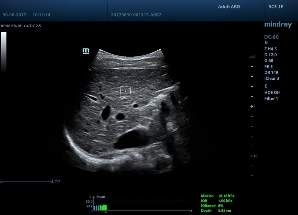 Mindray DC-80 X-Insight
